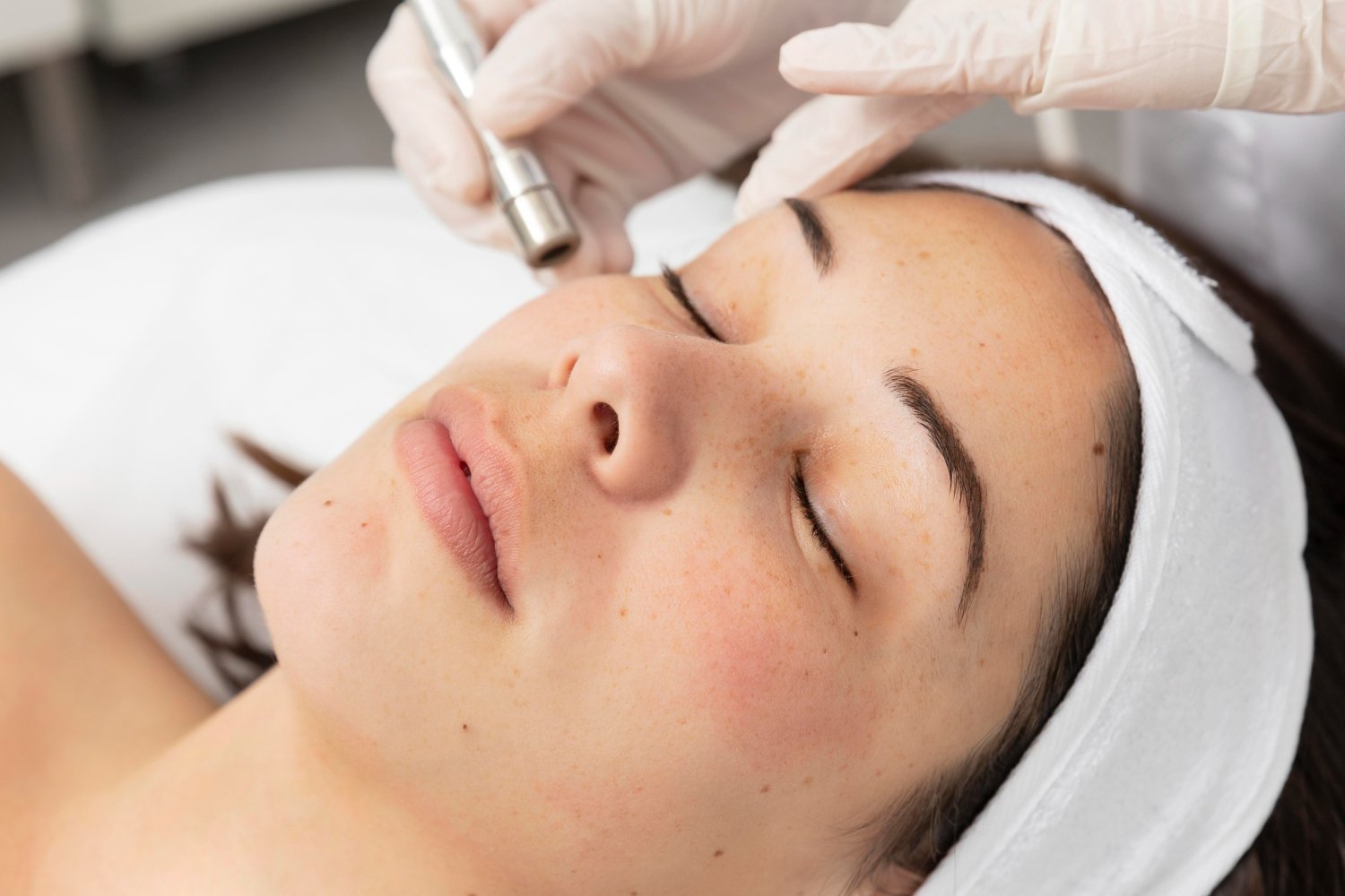microneedling facial