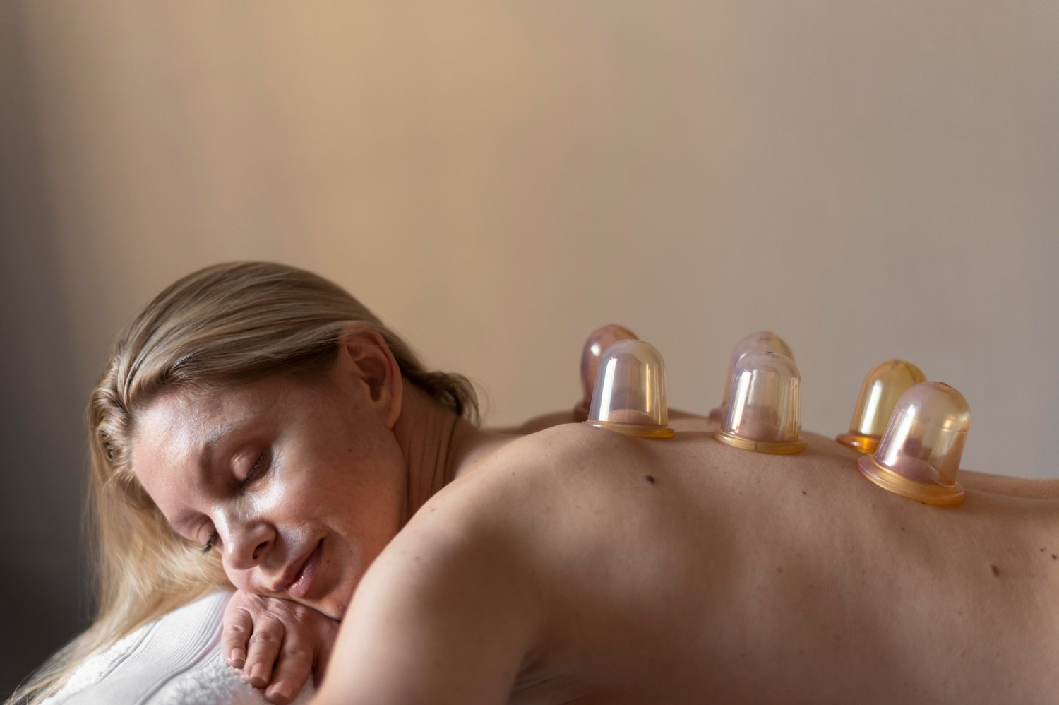cupping therapy